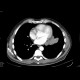 Metastases of lung and mediastinum: CT - Computed tomography